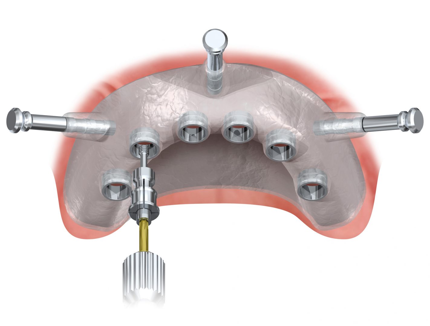 Surgical Guides Digicad Dental Studio